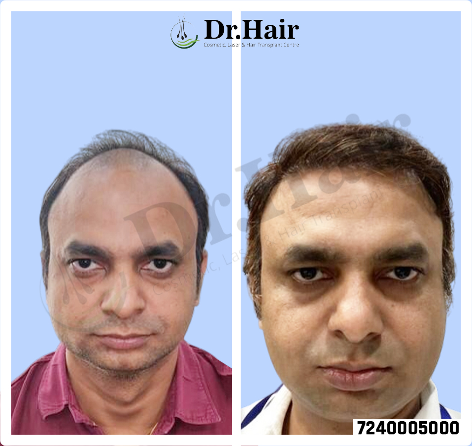 Hair Transplant Result 1