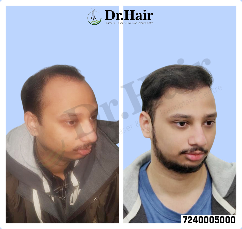 Hair Transplant Result 1