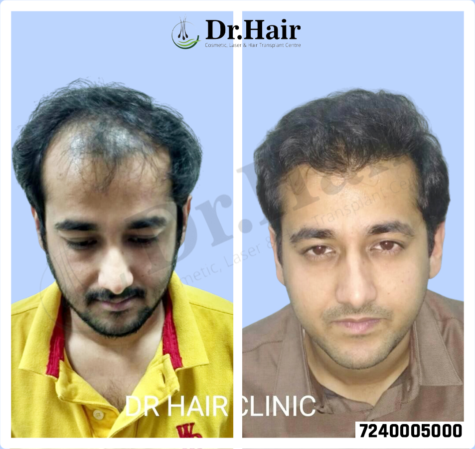 Hair Transplant Result 1
