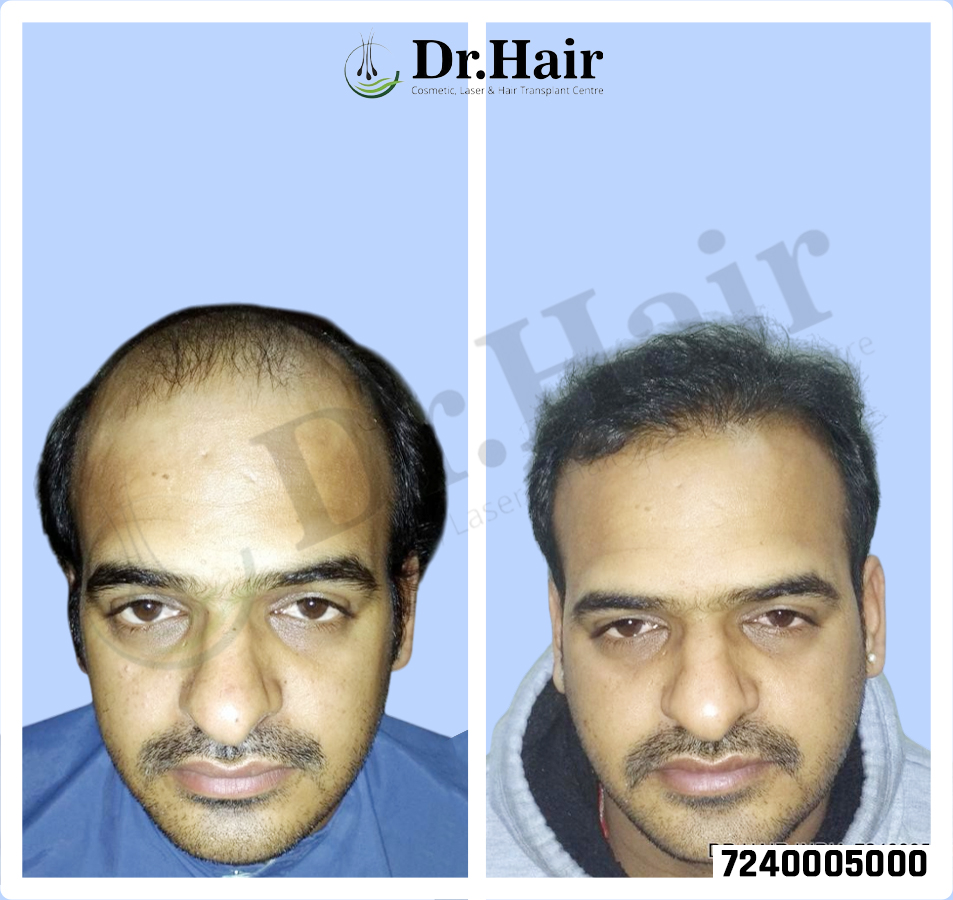 Hair Transplant Result 1