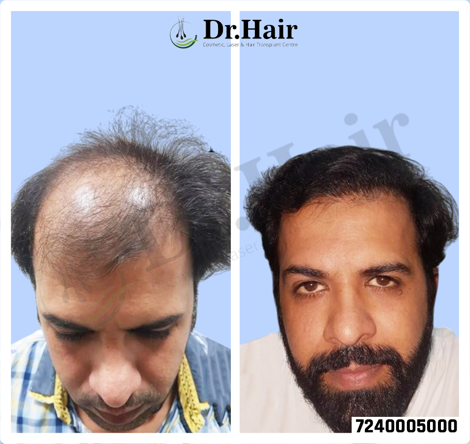 Hair Transplant Result 1