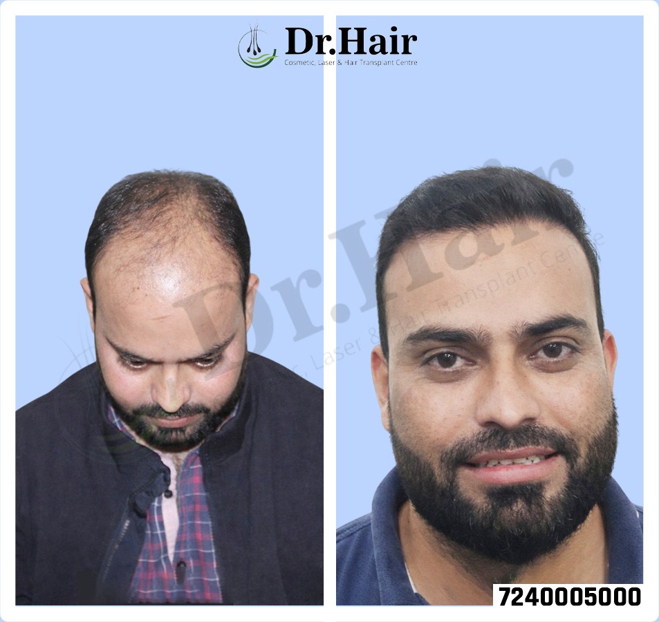 Hair Transplant Result 1