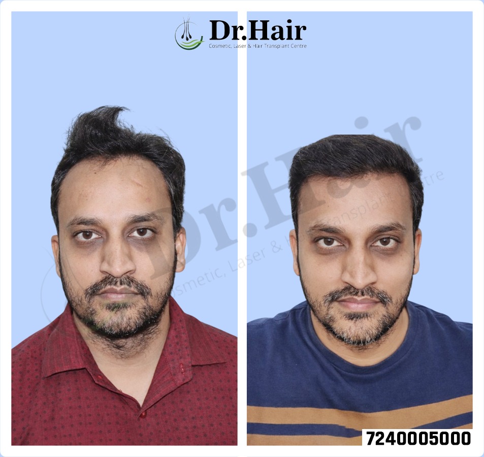 Hair Transplant Result 1
