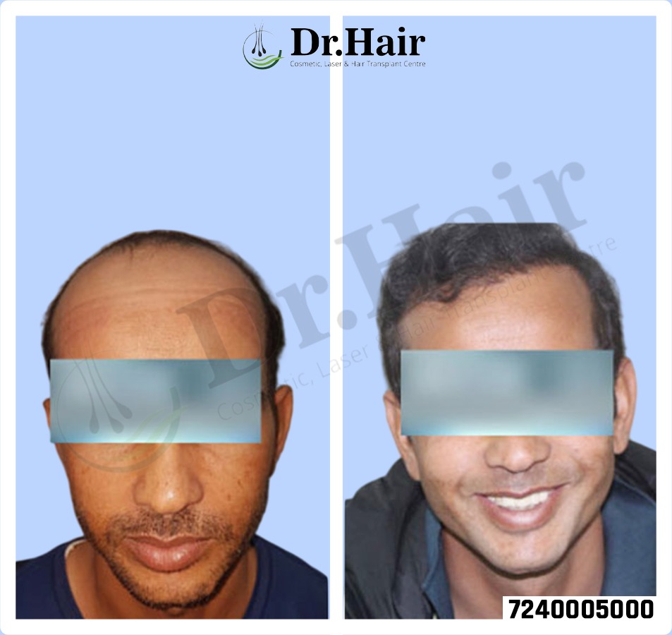 Hair Transplant Result 1