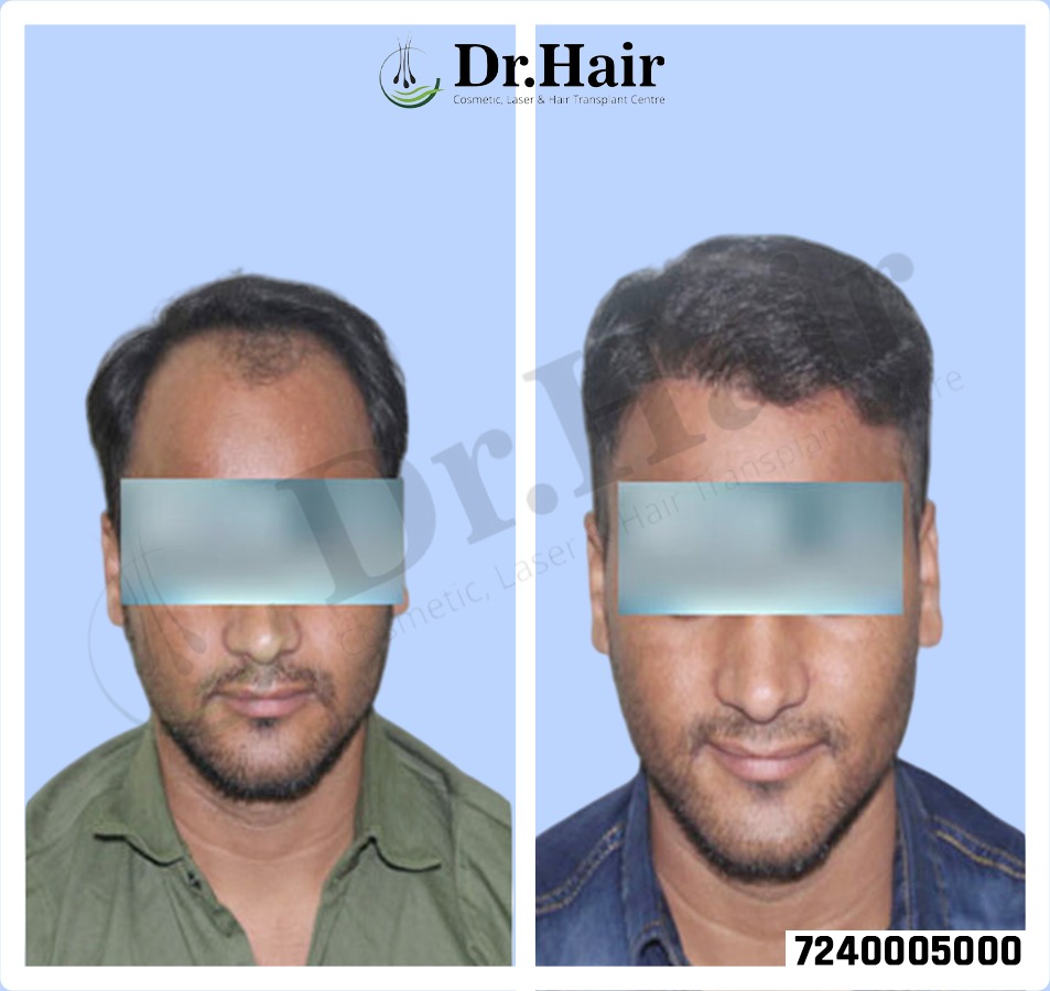 Hair Transplant Result 1