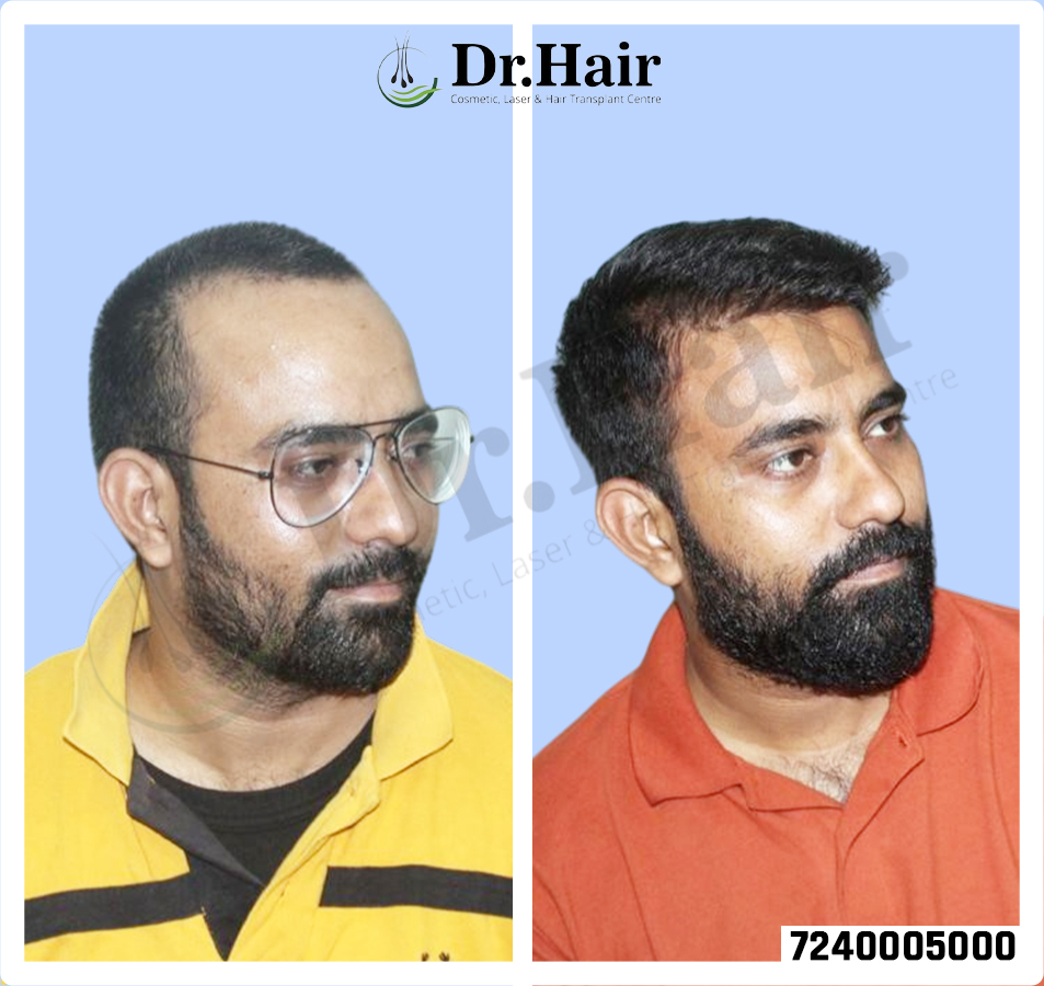 Hair Transplant Result 1